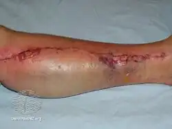 Diabetic bullae