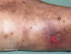 Diabetic bullae