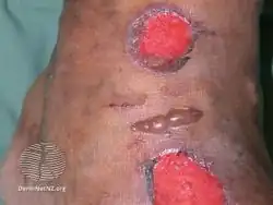 Diabetic bullae