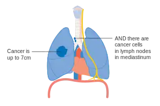 Stage IIIA lung cancer