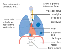 Stage IIIB lung cancer