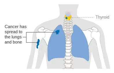 Stage M1 thyroid cancer