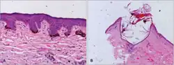 Skin biopsy