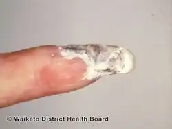 Dry gangrene