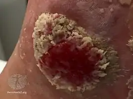 Eccrine poroma
