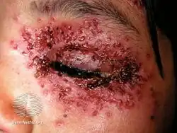 Eczema herpeticum