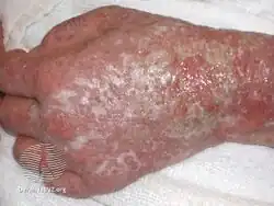 Eczema herpeticum