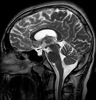 Empty sella in MRI