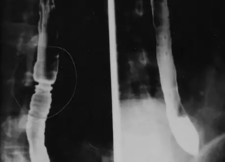 The barium swallow of the esophagus on the left side shows multiple rings associated with eosinophilic esophagitis.