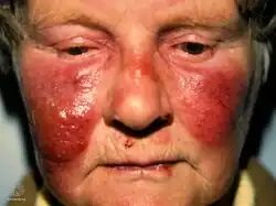 Erysipelas face