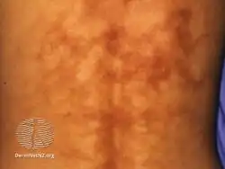 Erythema ab igne