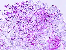 Esophageal candidiasis stained by periodic acid-Schiff procedure