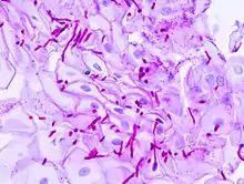 Esophageal candidiasis stained by periodic acid-Schiff procedure