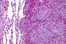 Micrograph of metastatic Ewing sarcoma (right of image) in normal lung (left of image). PAS stain