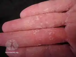 Keratolysis exfoliativa