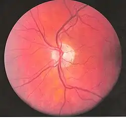 Eye vessels