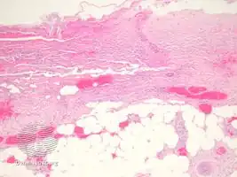 Warfarin necrosis