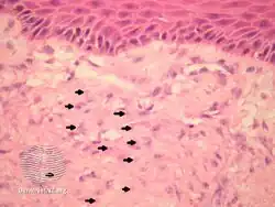 Infantile digital fibromatosis/pathology