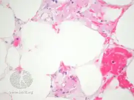 Warfarin necrosis