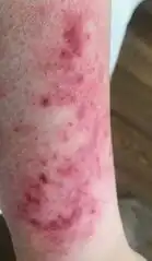 Erysipeloid lesion