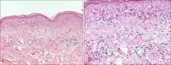 Basal vacuolation