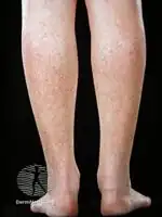 Flegel disease