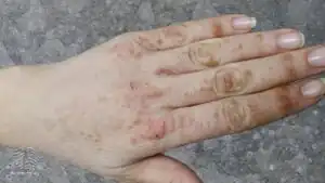 Hand-foot syndrome due to sorafenib