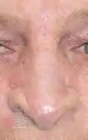 Healed wound after skin graft