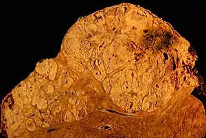 Cirrhosis leading to hepatocellular carcinoma (autopsy specimen)