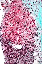 Mallory bodies in hepatocellular carcinoma. Trichrome stain.