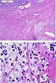 Signet ring cell carcinoma of the ileum. H&E stain