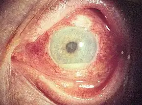 A person with hypopyon which can be seen in anterior uveitis in a person with Behçet's disease