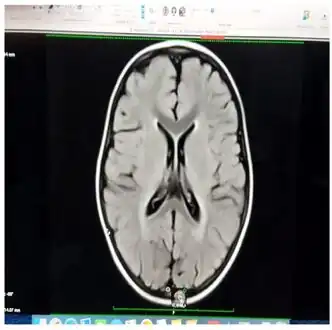 Iso intensity in bilateral periventricular deep white matter