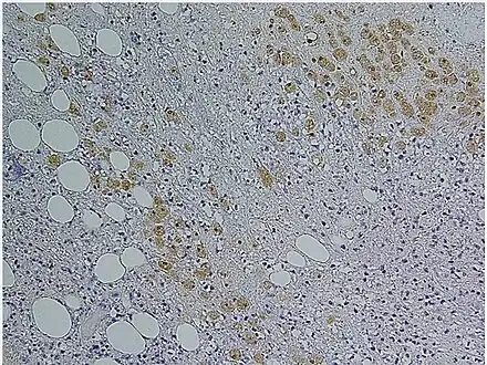 Immunohistochemical staining of trophozoites (brown) using specific anti–Entamoeba histolytica macrophage migration inhibitory factor antibodies in a patient with amebic colitis