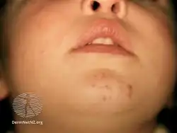 Infantile acne