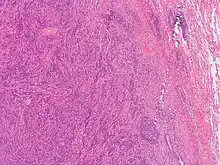 This image was originally posted to Flickr by Pulmonary Pathology at https://flickr.com/photos/30950973@N03/5601450952 (archive). It was reviewed on 3 October 2019 by FlickreviewR 2 and was confirmed to be licensed under the terms of the cc-by-sa-2.0.