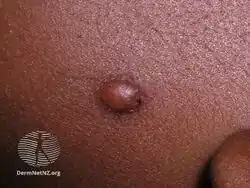 Juvenile xanthogranuloma