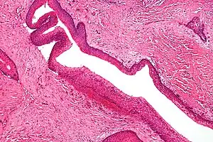 Intermediate magnification of an odontogenic keratocyst