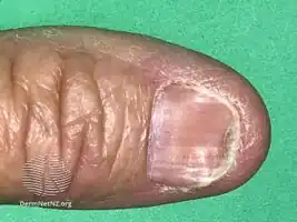 Koilonychia
