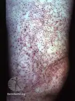 Kyrle disease