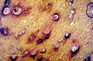 Kyrle disease