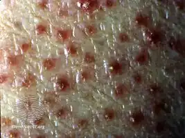 Kyrle disease