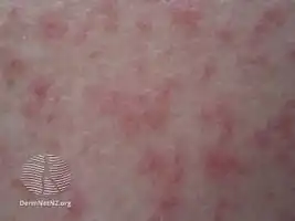 Leukemia cutis