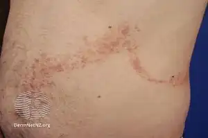 Lichen planus