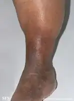 Lipodermatosclerosis