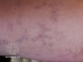 Livedo racemosa