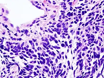 Histopathologic image of small-cell carcinoma of the lung. CT-guided core needle biopsy.