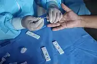 A point of care test in Peru. A blood droplet is collected by a pipette.
