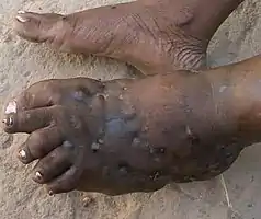 Madura foot