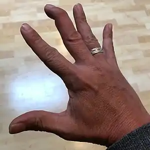 Appearance: the last joint cannot be straightened. See mallet finger